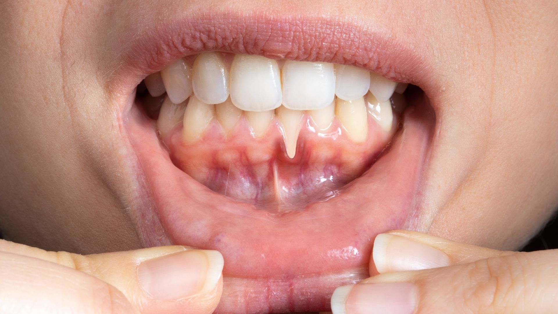 Periodontitis & Gingival Retraction