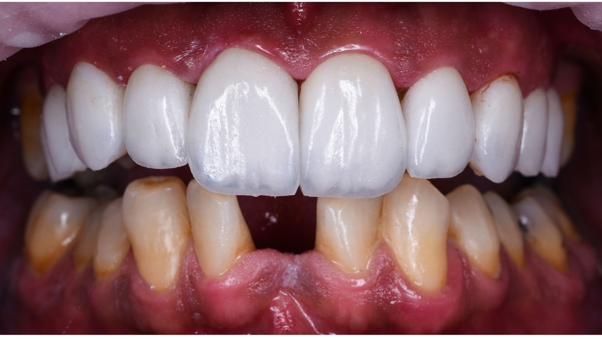 Zirconium Porcelain Crowns