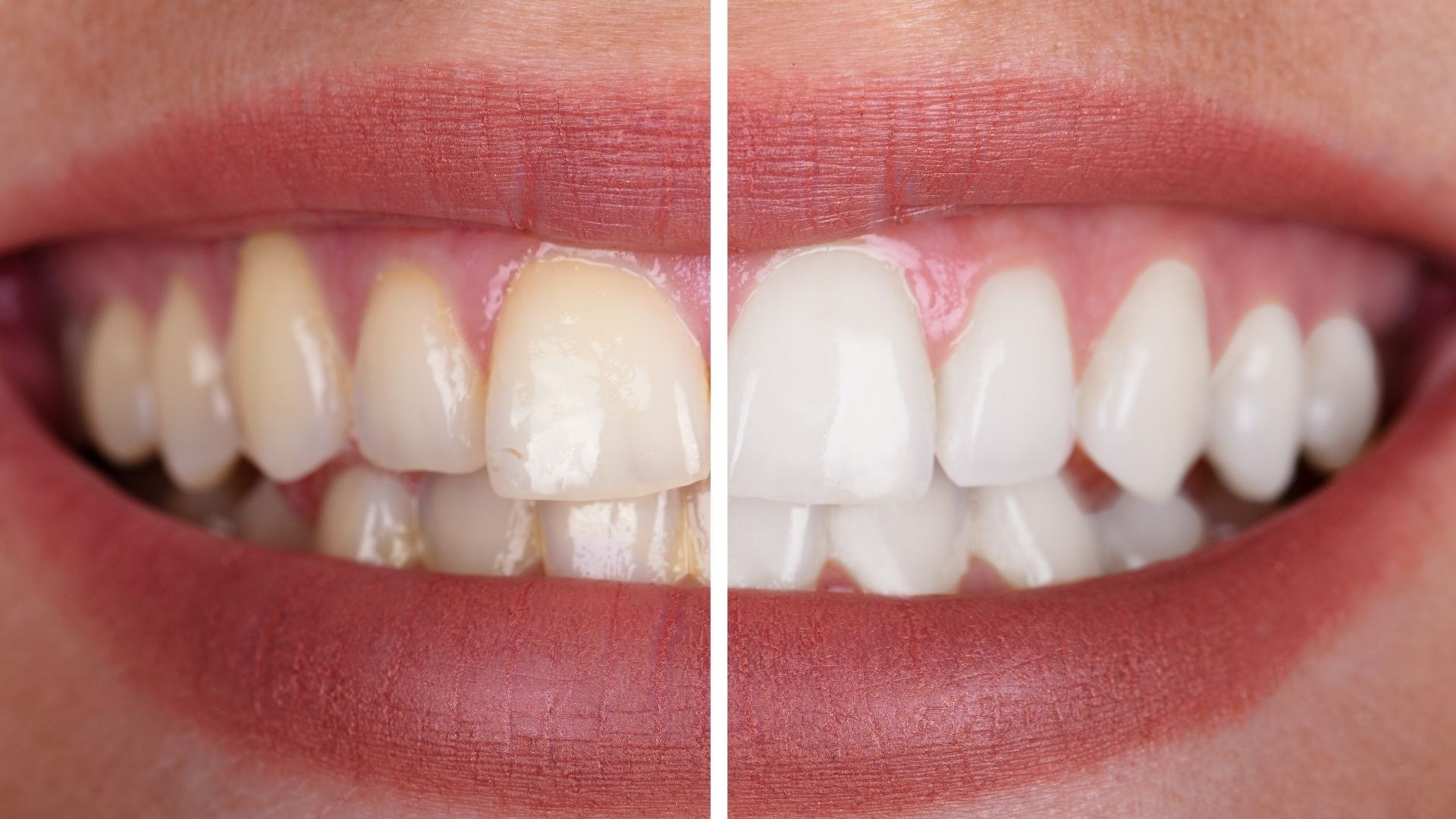 Teeth Whitening Process & Aesthetic Dentistry